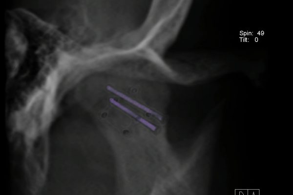 Case 1 CBCT Head Fracture With Screws